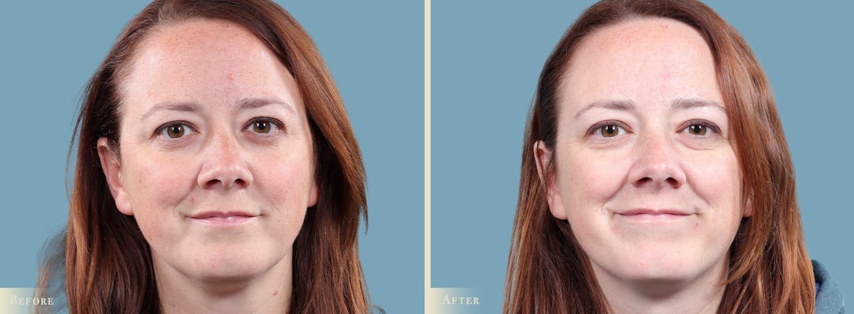 Mole Removal Before & After Gallery - Patient 173135 - Image 1