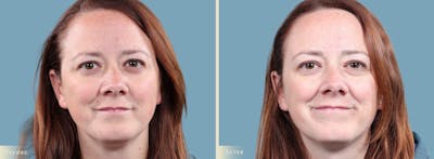 Mole Removal Before & After Gallery - Patient 173135 - Image 1