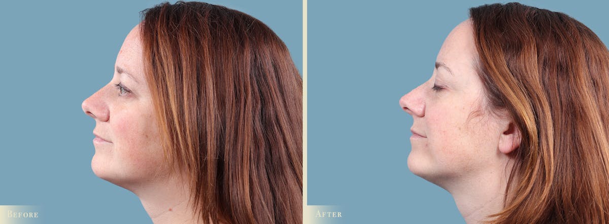 Mole Removal Before & After Gallery - Patient 173135 - Image 2