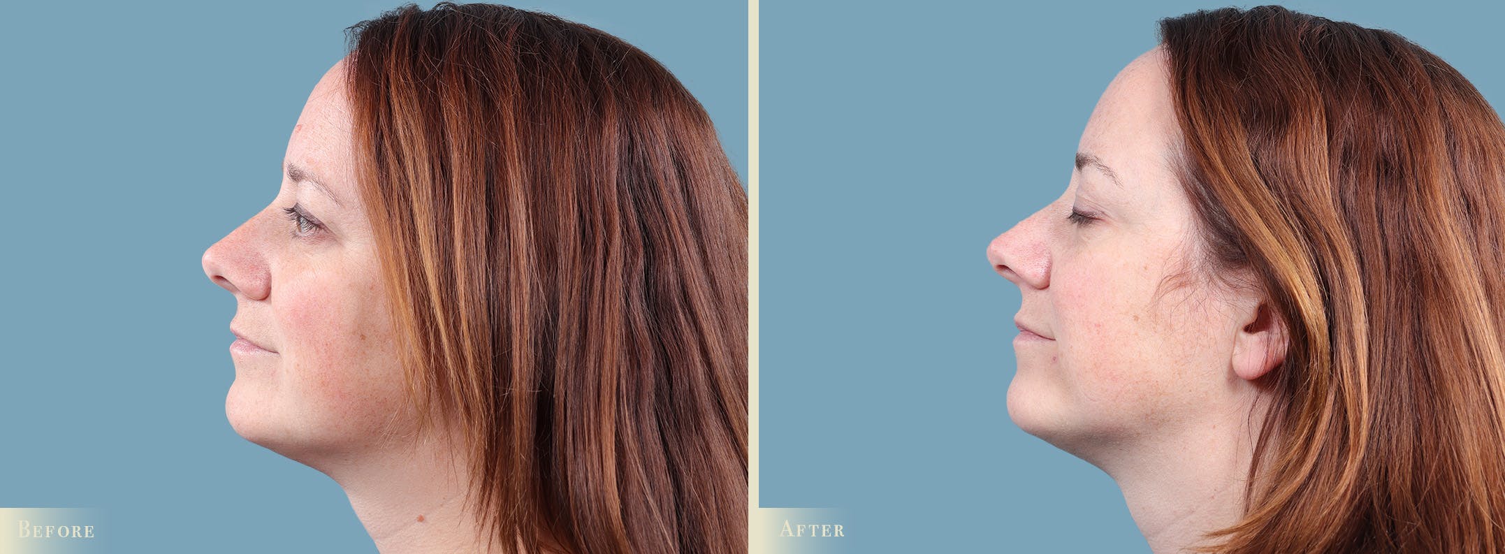 Mole Removal Before & After Gallery - Patient 173135 - Image 2