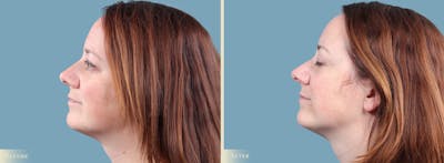 Mole Removal Before & After Gallery - Patient 173135 - Image 2