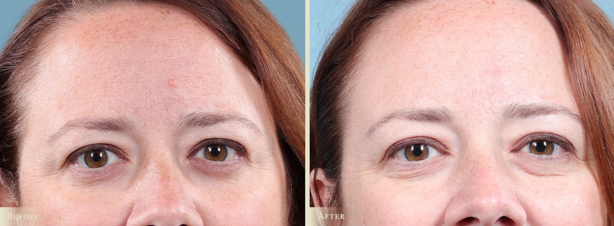 Mole Removal Before & After Gallery - Patient 173135 - Image 3