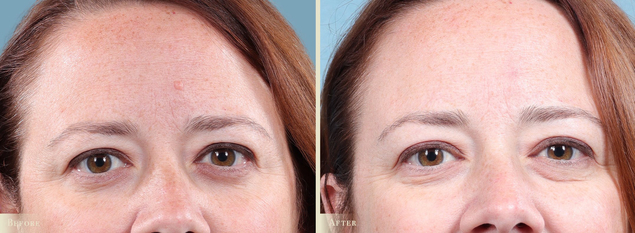 Mole Removal Before & After Gallery - Patient 173135 - Image 3