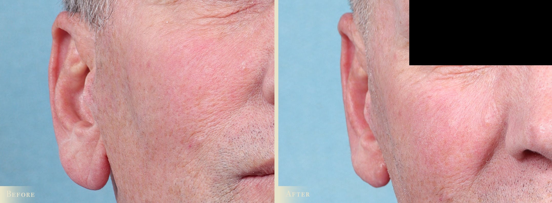 Earlobe Repair Before & After Gallery - Patient 874961 - Image 1