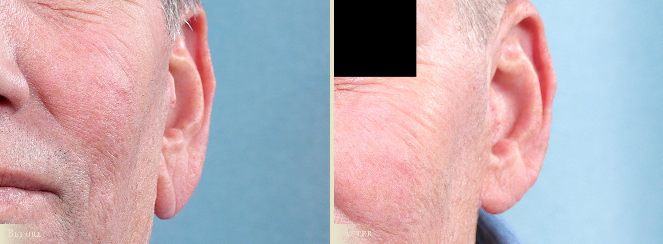 Earlobe Repair Before & After Gallery - Patient 874961 - Image 2