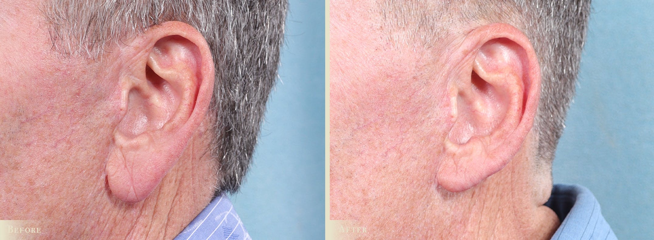 Earlobe Repair Before & After Gallery - Patient 874961 - Image 3
