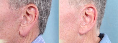 Earlobe Repair Before & After Gallery - Patient 874961 - Image 3