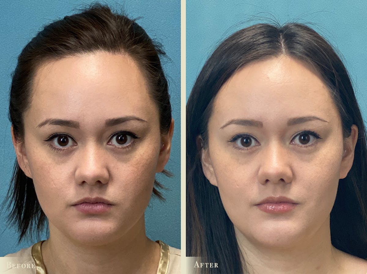 Buccal Fat Removal Before & After Gallery - Patient 269764 - Image 1
