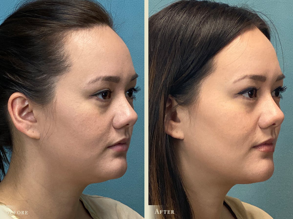 Buccal Fat Removal Before & After Gallery - Patient 269764 - Image 2