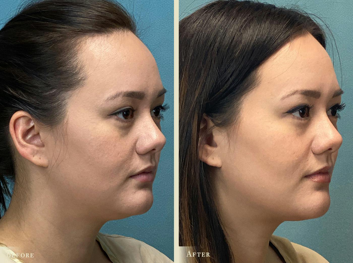 Buccal Fat Removal Before & After Gallery - Patient 269764 - Image 2