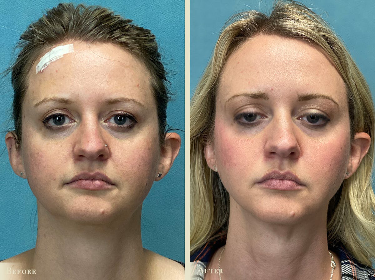 Buccal Fat Removal Before & After Gallery - Patient 190515 - Image 1