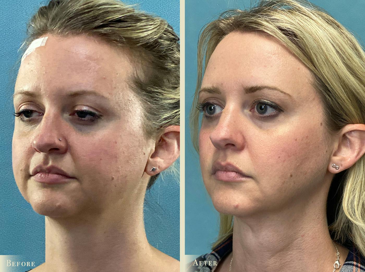 Buccal Fat Removal Before & After Gallery - Patient 190515 - Image 2