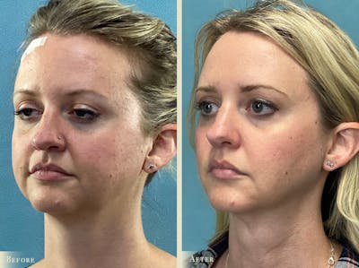 Buccal Fat Removal Before & After Gallery - Patient 190515 - Image 2