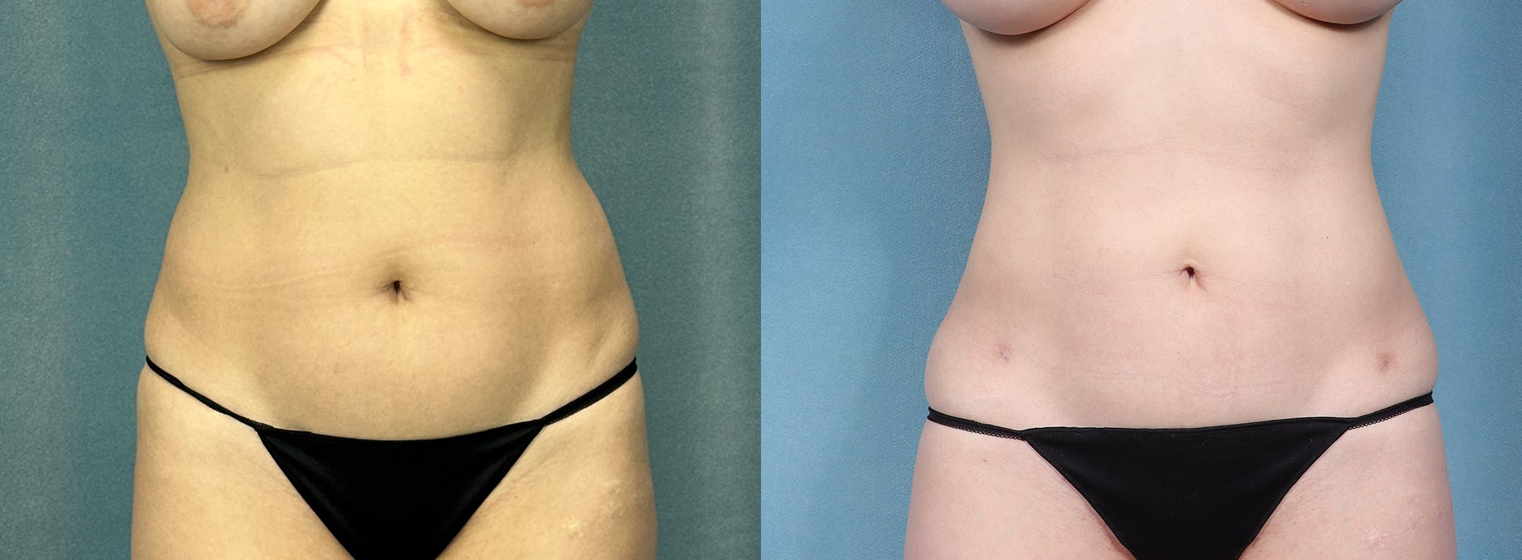 Female Liposuction Before & After Gallery - Patient 204848 - Image 1