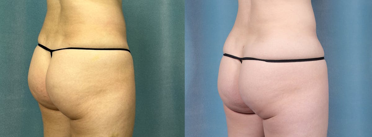 Female Liposuction Before & After Gallery - Patient 204848 - Image 3