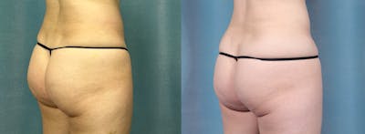 Female Liposuction Before & After Gallery - Patient 204848 - Image 3