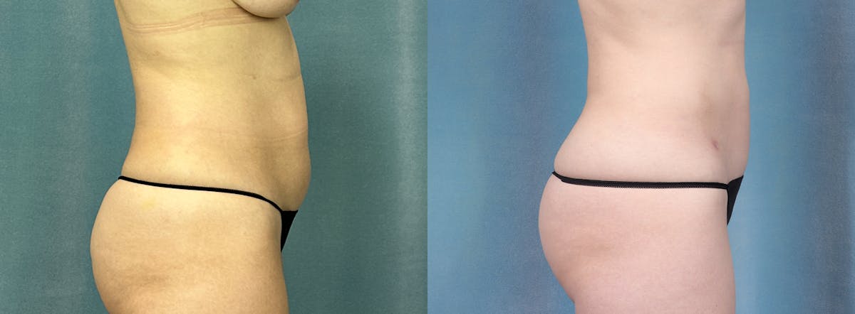 Female Liposuction Before & After Gallery - Patient 204848 - Image 2
