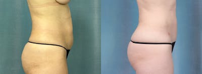 Female Liposuction Before & After Gallery - Patient 204848 - Image 2