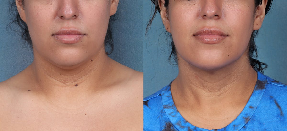 Neck Liposuction Before & After Gallery - Patient 310977 - Image 1