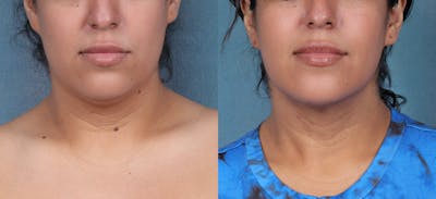 Neck Liposuction Before & After Gallery - Patient 310977 - Image 1