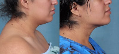 Neck Liposuction Before & After Gallery - Patient 310977 - Image 2