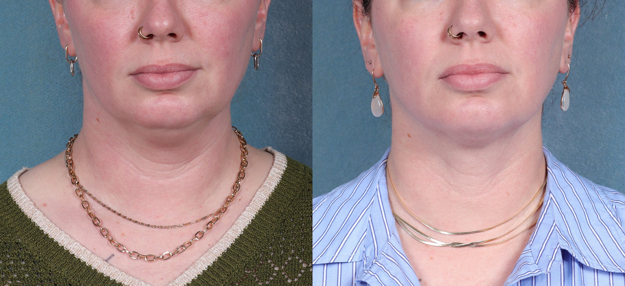 Neck Liposuction Before & After Gallery - Patient 190012 - Image 1