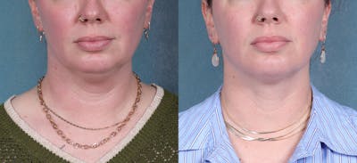 Neck Liposuction Before & After Gallery - Patient 190012 - Image 1