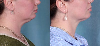 Neck Liposuction Before & After Gallery - Patient 190012 - Image 2