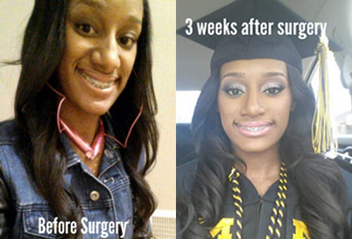 Before and after photos of Alexis