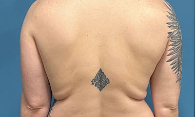 CoolSculpting Before & After Gallery - Patient 607190 - Image 1