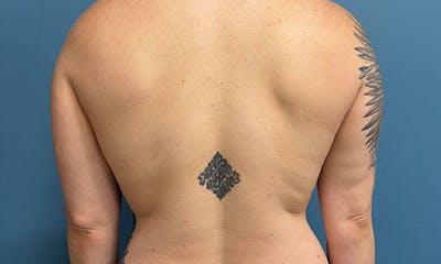 CoolSculpting Before & After Gallery - Patient 607190 - Image 2