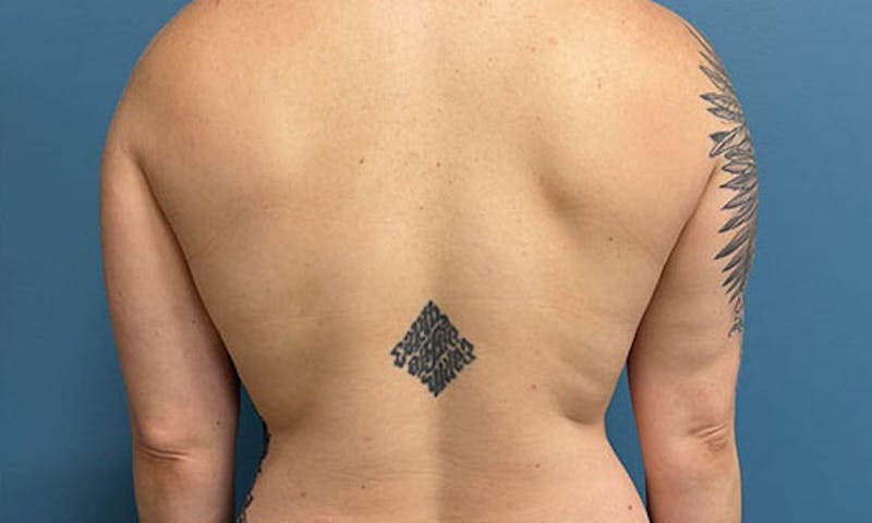 CoolSculpting Before & After Gallery - Patient 607190 - Image 2