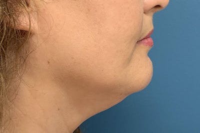 CoolSculpting Before & After Gallery - Patient 128982 - Image 1