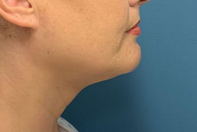 CoolSculpting Before & After Gallery - Patient 128982 - Image 2