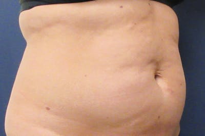 CoolSculpting Before & After Gallery - Patient 305185 - Image 1