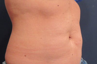 CoolSculpting Before & After Gallery - Patient 305185 - Image 2