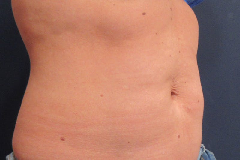 CoolSculpting Before & After Gallery - Patient 305185 - Image 2