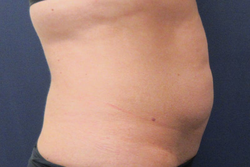 CoolSculpting Before & After Gallery - Patient 305185 - Image 3