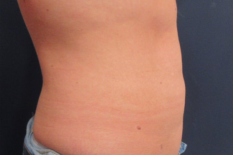 CoolSculpting Before & After Gallery - Patient 305185 - Image 4