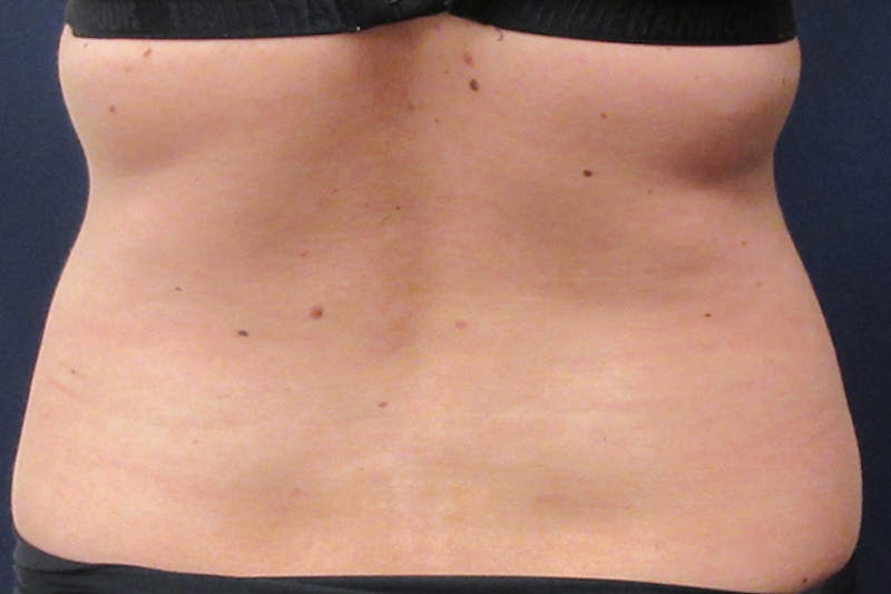 CoolSculpting Before & After Gallery - Patient 305185 - Image 5