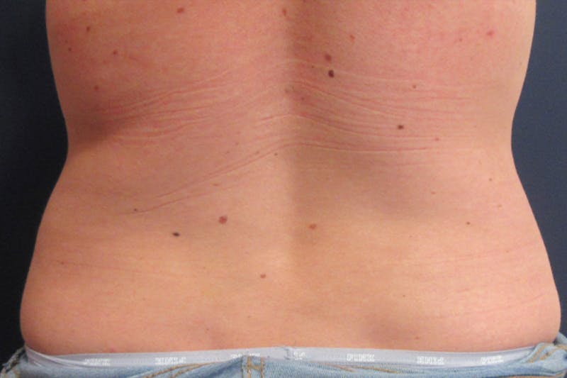 CoolSculpting Before & After Gallery - Patient 305185 - Image 6