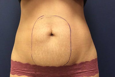 CoolSculpting Before & After Gallery - Patient 545287 - Image 1