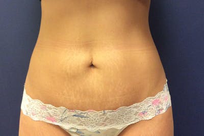 CoolSculpting Before & After Gallery - Patient 545287 - Image 2