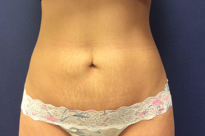 CoolSculpting Before & After Gallery - Patient 545287 - Image 2