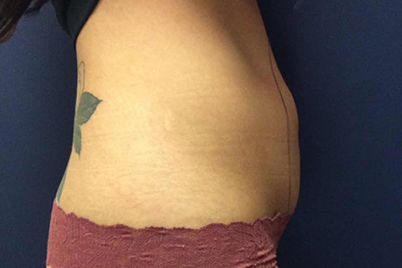 CoolSculpting Before & After Gallery - Patient 545287 - Image 3