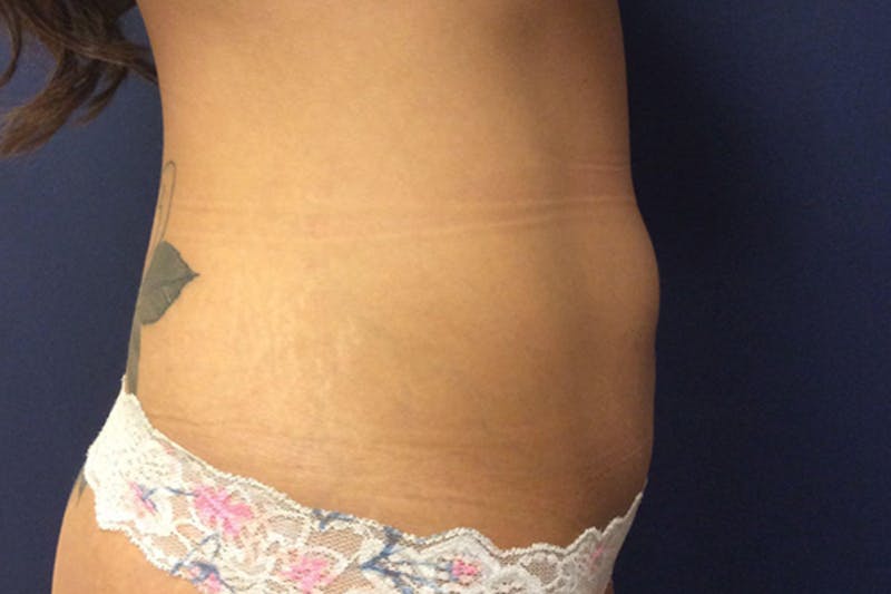 CoolSculpting Before & After Gallery - Patient 545287 - Image 4