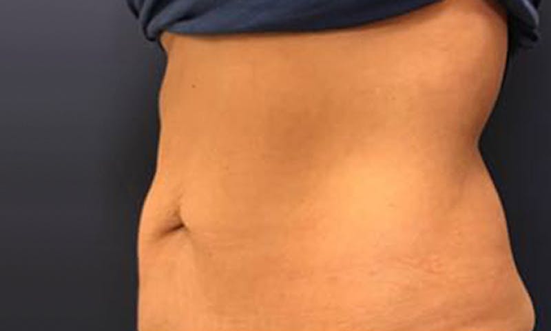 CoolSculpting Before & After Gallery - Patient 272783 - Image 1