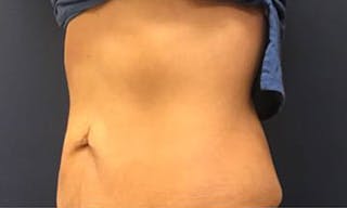 CoolSculpting Before & After Gallery - Patient 272783 - Image 2