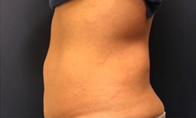 CoolSculpting Before & After Gallery - Patient 272783 - Image 3