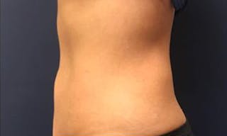 CoolSculpting Before & After Gallery - Patient 272783 - Image 4
